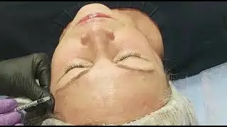 Коррекция морщин ботоксом, лоб, круговая мышца глаза.