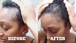 How I Grew My Edges Back Using Wild Growth Hair Oil