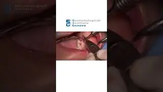 OTTAVI INCLUSI E SEMINCLUSI - OSTECTOMIA #thirdmolars #surgicaltecnique #surgicalvelocity