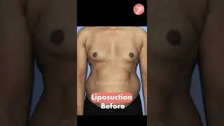 Liposuction Before and After | Liposuction Result | Liposuction Surgery Before After | SB Aesthetics