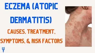 Eczema (Atopic Dermatitis) Causes, Treatment, Symptoms