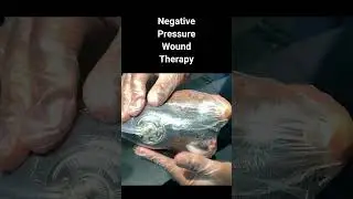 Saving A Foot: Preventing Amputation