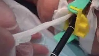 heliosphere Intragastric balloon for weight loss