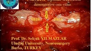 thoracic spinal stenosis