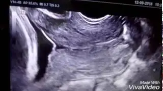 CERVICOMETRIA Predictor de parto pretermino