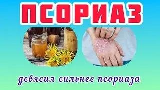 Псориаз - Лечение Болезни Отваром Девясила