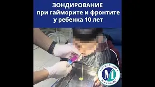 Зондирование при гайморите и фронтите у ребенка 10 лет.