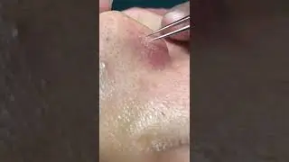 How to Remove Sebum from the Nose