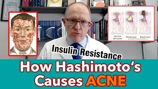 How Hashimoto's Causes Acne (and what to do about it )