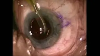 Phacoemulsification: OVD (Viscoelastic) Removal [ARCHIVE]