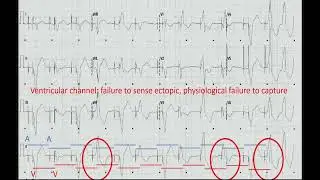 INTERACTIVE ECG CASES & EP Traces