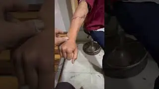 Extensor Tendon repair with impressive result after one year follow up.