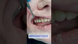 Установка коронок на имплантате. Installation of crowns on the implant. Implantation.