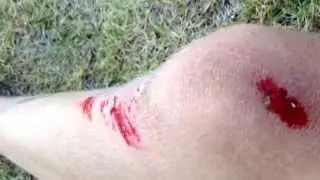 BMX fail Don't watch this!!