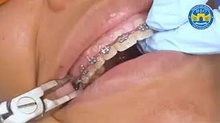 Braces Removal and Retainers on the SAME DAY