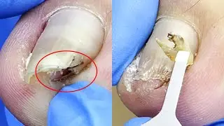 Pedicure Tutorial：Amazing! Hooks under toenails【Pedicure Master Lin Jun】