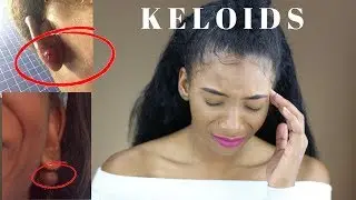 My Keloid Story *EXPLICIT* with Photos (How to get rid of them + What are they) | Annesha Adams