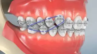 Labially Displaced Cuspids 45