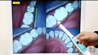 Best Wireless Intraoral Camera Review