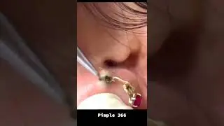 Why You Should Blackheads Remove a Little Every Day ID 00 133