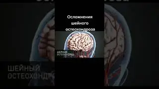 #инсульт