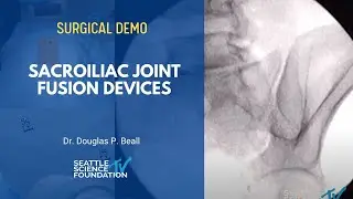Sacroiliac Joint Fusion Devices - Ramana Naidu, M.D.