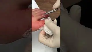 Toenail Removal with Nail bed Laceration Repair