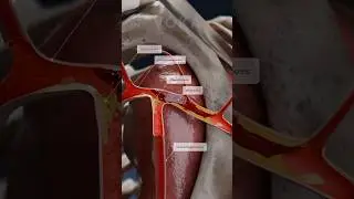 Thrombosis 3D animation | clot formation in the subclavian artery explained in 3D with VOKA