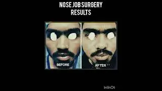 NOSE JOB SURGERY/OPEN RHINOPLASTY RESULTS ARE ABSOLUTELY AMAZING 😍🤩👌👌👏👏