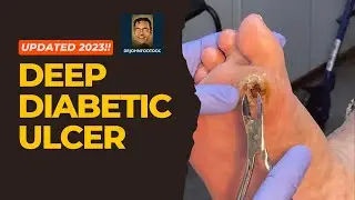 How to Cure Deep Diabetic Ulcers Fast