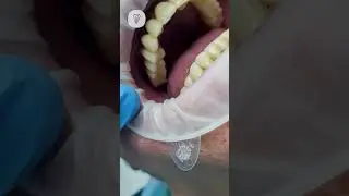 Поэтапное лечение на пути к новой, красивой и здоровой улыбке. Имплантация зубов.