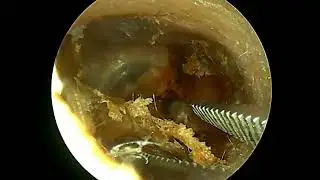 Skin Peeling Abnormal Ear