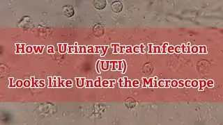 Urinary Tract Infection (UTI) Under the Microscope | Pus Cells in Urine