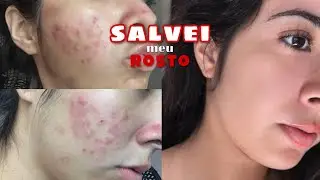 COMO ME LIVREI DAS ESPINHAS - esse método é MILAGROSO! 😱😍 (sem roacutan)