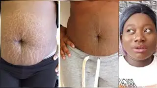 you will never get stretch marks after using this effective remedy