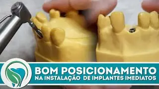 Garantindo um bom posicionamento na instalação de implantes imediatos