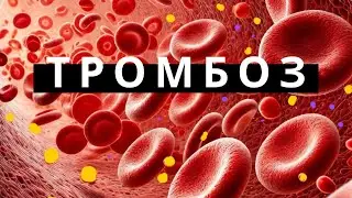 КАК ОБРАЗУЕТСЯ ТРОМБ