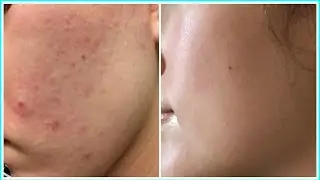 EXTREME ACCUTANE TRANSFORMATION! BEFORE & AFTER PHOTOS!