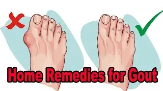 Home Remedies for Gout - 8 Natural Home Remedies for Gout
