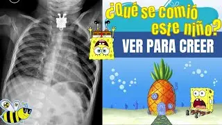 INGESTION DE CUERPO EXTRAÑO