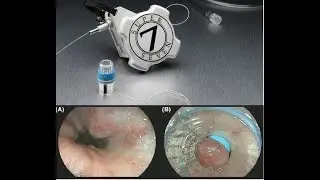 Endoscopic banding for esophageal varices step by step| Super speed 7 band| Dr. Pandiaraja