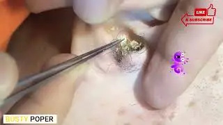 BIG Ear Wax Removal || Busty Poper