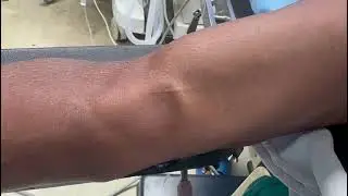 Visible pulsations of brachial artery