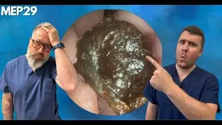 The Stubborn Ear Wax Plug Removal - MEP29
