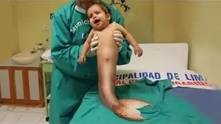 Bebé nace con la sirena de cola