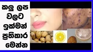 මුහුණේ ඇති කළු ලප වලට ඉක්මන් ප්‍රතිකාර මෙන්න - Remove DARK SPOTS Permanently
