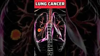 LUNG CANCER #lungcancersymptoms #lungcancer