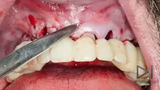 dr.Giampiero Ciabattoni Digital Implantology Video Channel