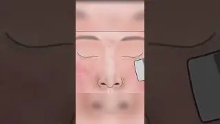 Asmr blackhead remove on nose 