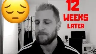 hair transplant turkey 12 weeks update